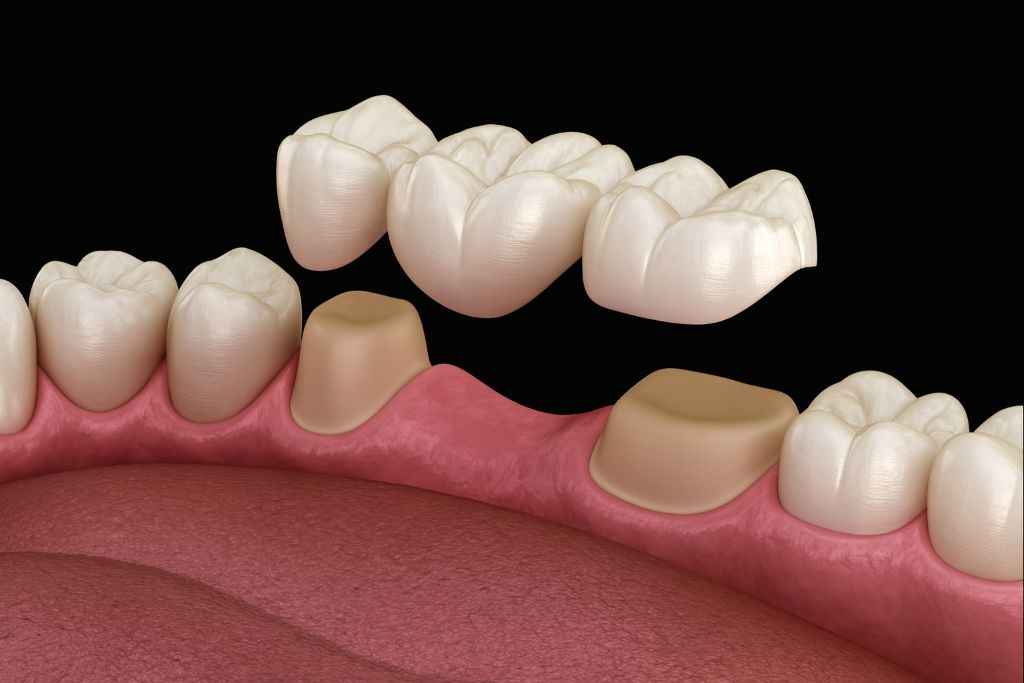 Dental Bridge